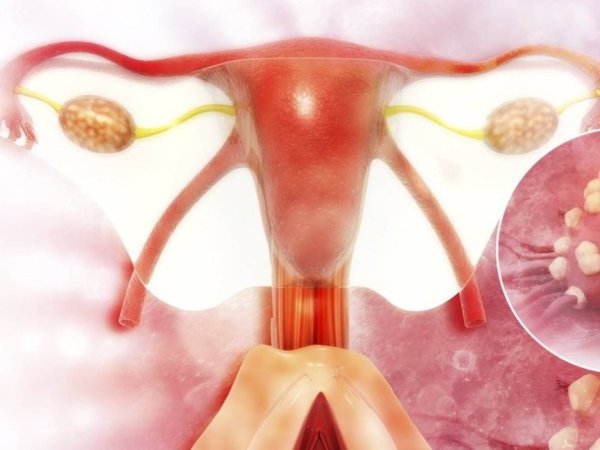 El Cáncer de ovario representa una alta legalidad
