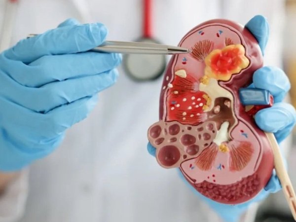Cáncer de Riñón: Tipos y factores de riesgo | Radio Definición