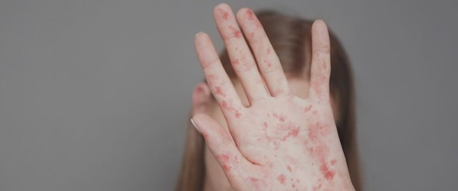 Experto del Hospital Clínico de la Universidad de Antofagasta alerta por alta contagiosidad del sarampión